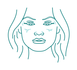 Ultrasound-guided facial vein treatment procedure