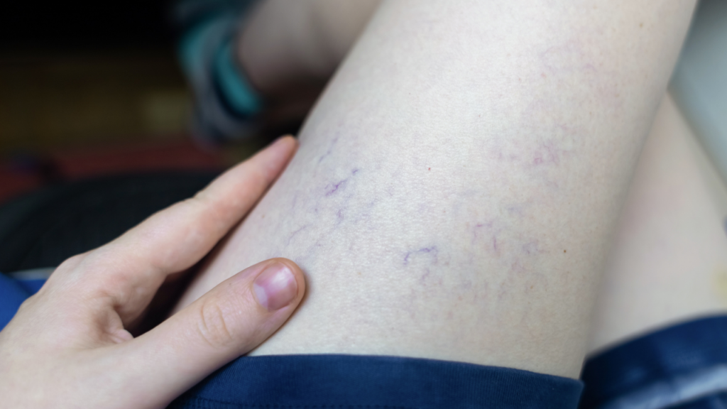 Spider veins visible on thigh skin showing early signs of venous insufficiency