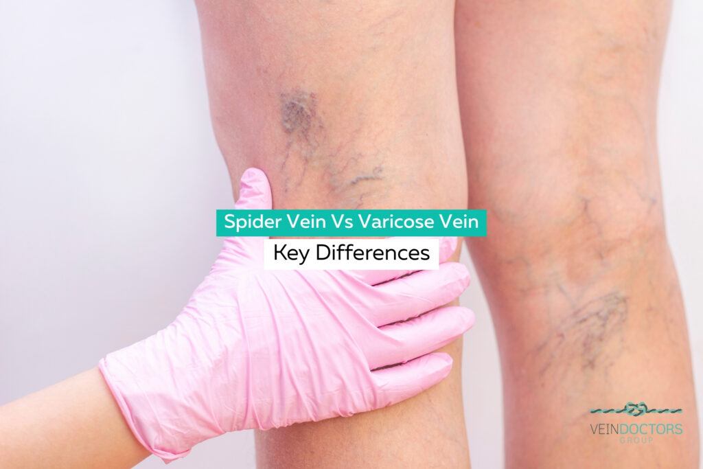 Spider Veins vs Varicose Veins: Key Differences