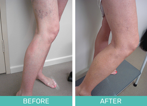 Reason for spider veins and the treatment results