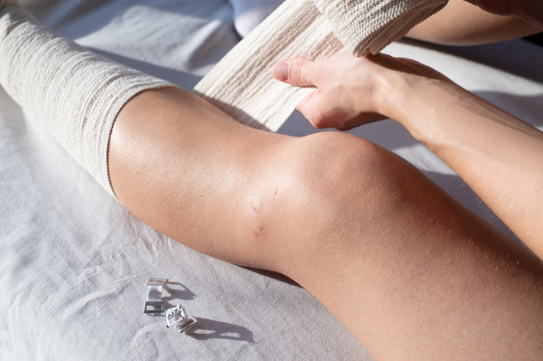 Venous Leg Ulcers